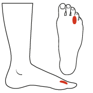 Morton's Neuroma